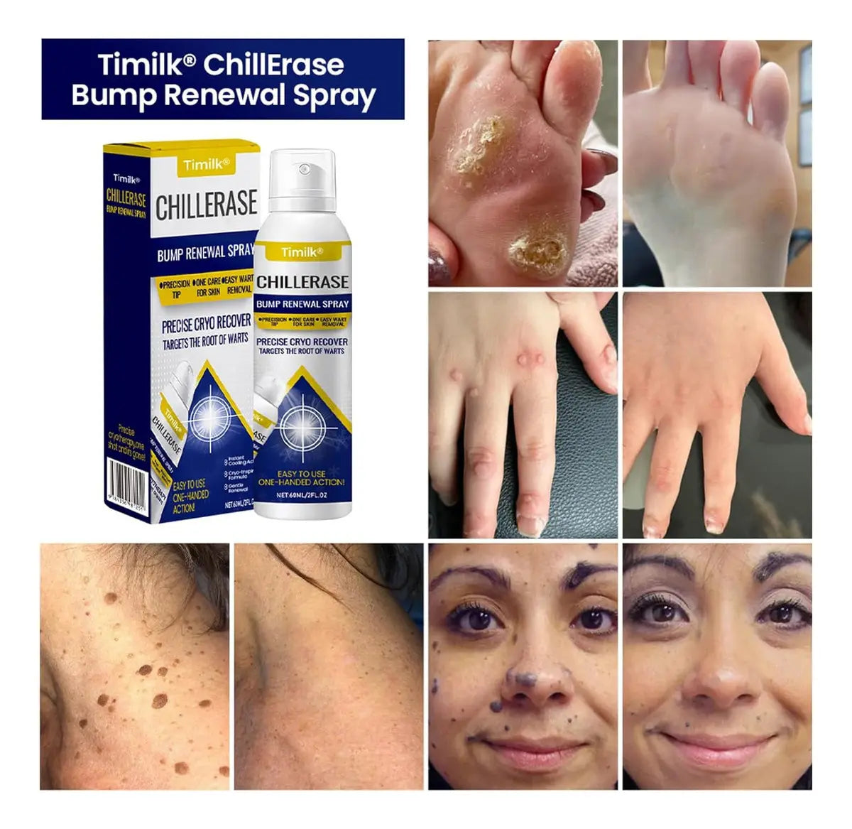 Spray con efecto frío: Elimina verrugas y protuberancias