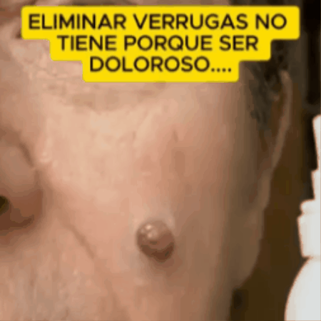Spray con efecto frío: Elimina verrugas y protuberancias